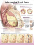 Understanding Breast Cancer Anatomical Chart, 2nd Edition